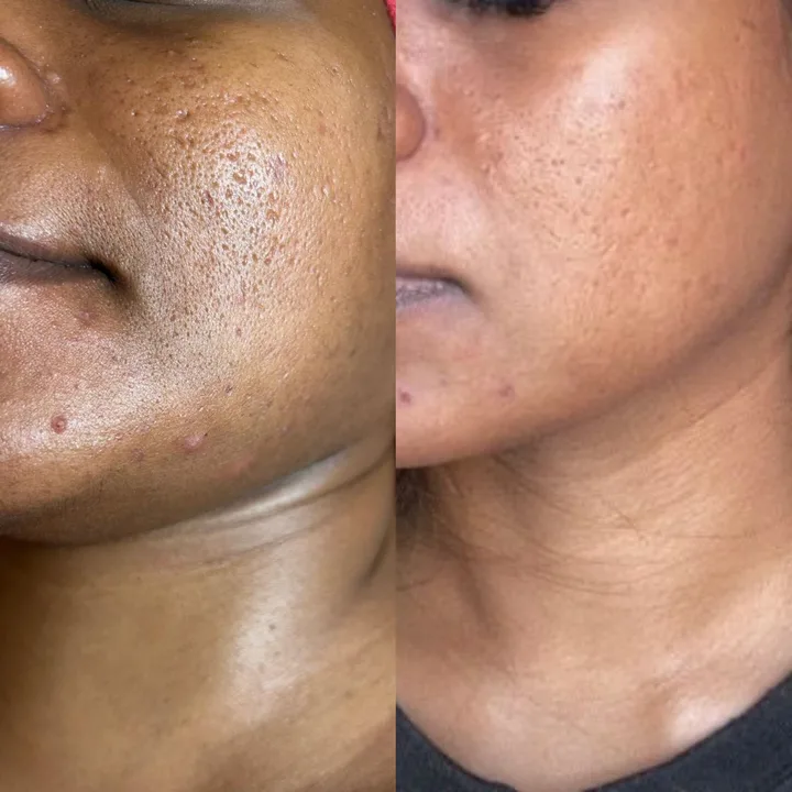 M-Plified Beauty client review or treatment result 2